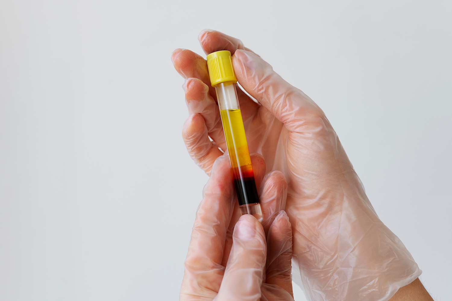 PRP Treatment in Stockport